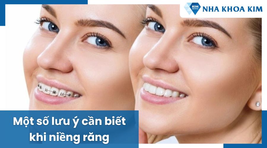 Những lưu ý giúp cải thiện góc nghiêng khi niềng răng