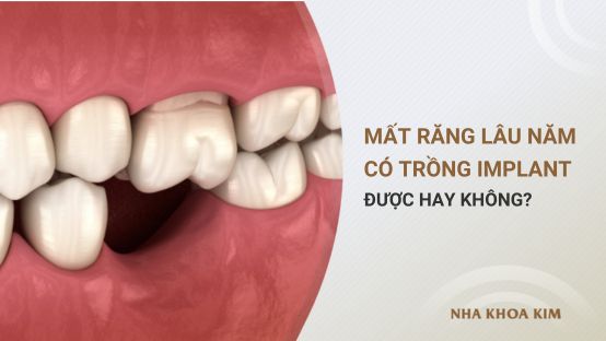 Mất răng lâu năm có trồng Implant được không? Giá bao nhiêu?