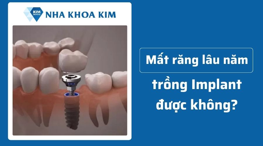 Mất răng lâu năm có trồng Implant được không?