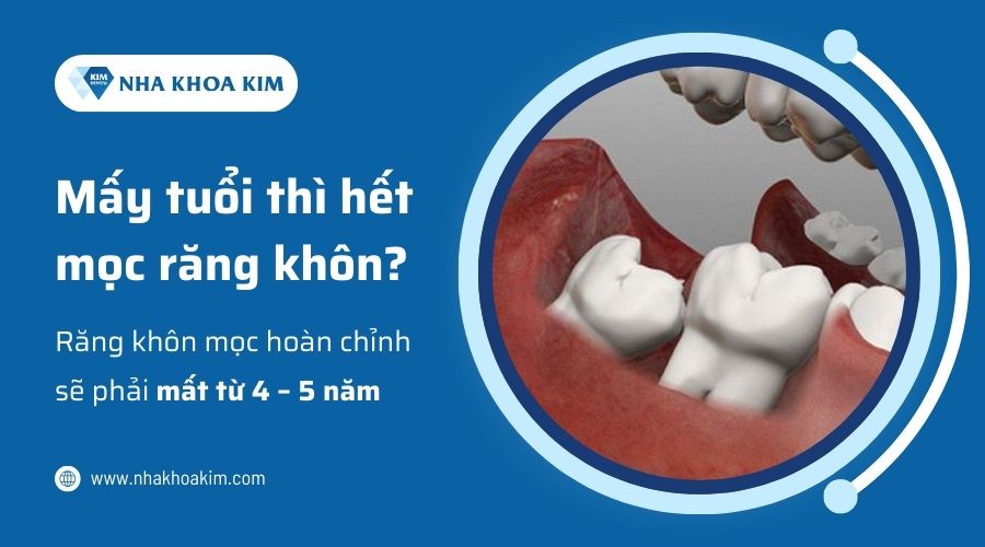 Mấy tuổi thì hết mọc răng khôn?