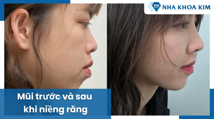 Niềng răng có giúp mũi cao hơn không?