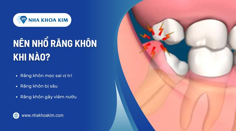 Nên nhổ răng khôn khi nào?