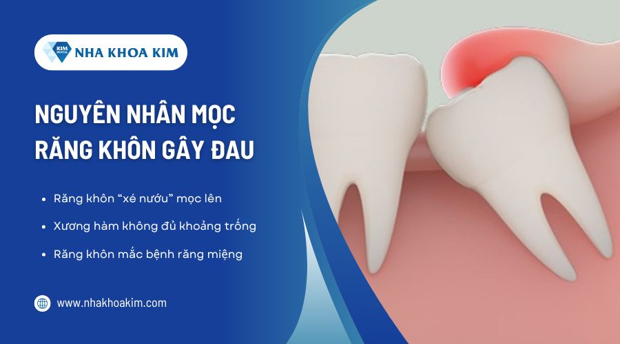 Nguyên nhân mọc răng khôn gây đau