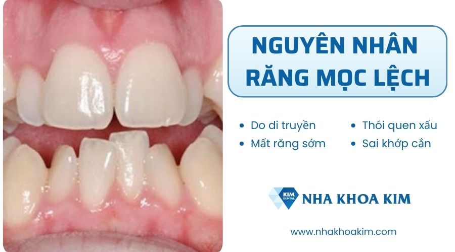 Nguyên nhân răng mọc lệch