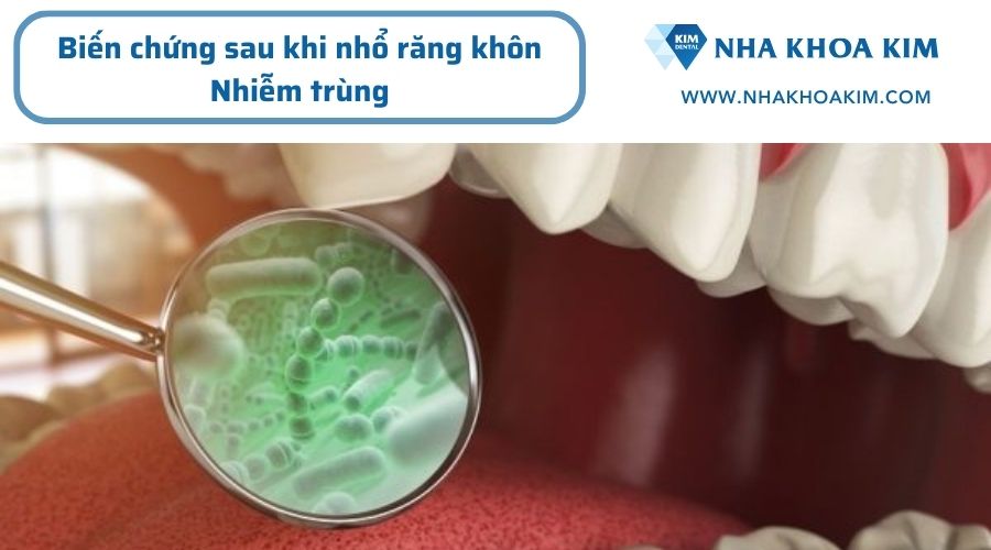 Biến chứng sau khi nhổ răng khôn gây nhiễm trùng