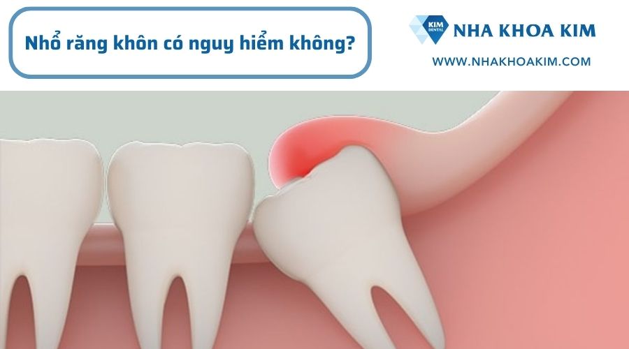 Nhổ răng khôn có nguy hiểm không?