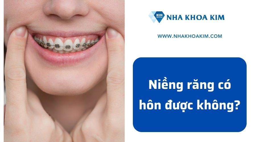 Niềng răng có hôn được không?