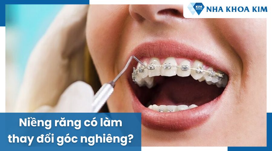 Niềng răng có làm thay đổi góc nghiêng không?