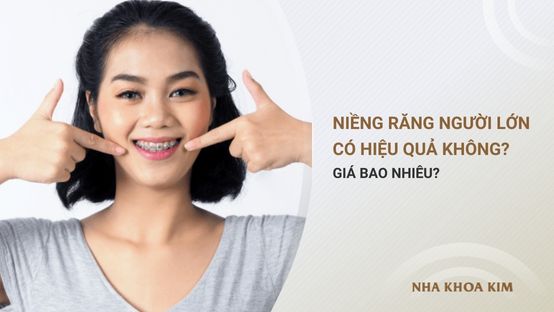 Niềng răng cho người lớn có hiệu quả không? Giá bao nhiêu?