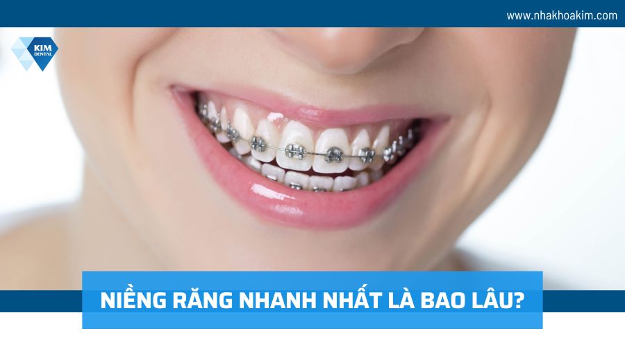 Niềng răng nhanh nhất là bao lâu?
