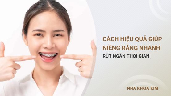 Cách giúp niềng răng nhanh, rút ngắn thời gian hiệu quả