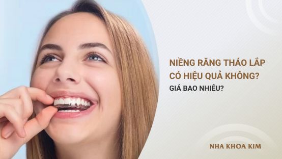 Niềng răng tháo lắp có hiệu quả không? Giá bao nhiêu?