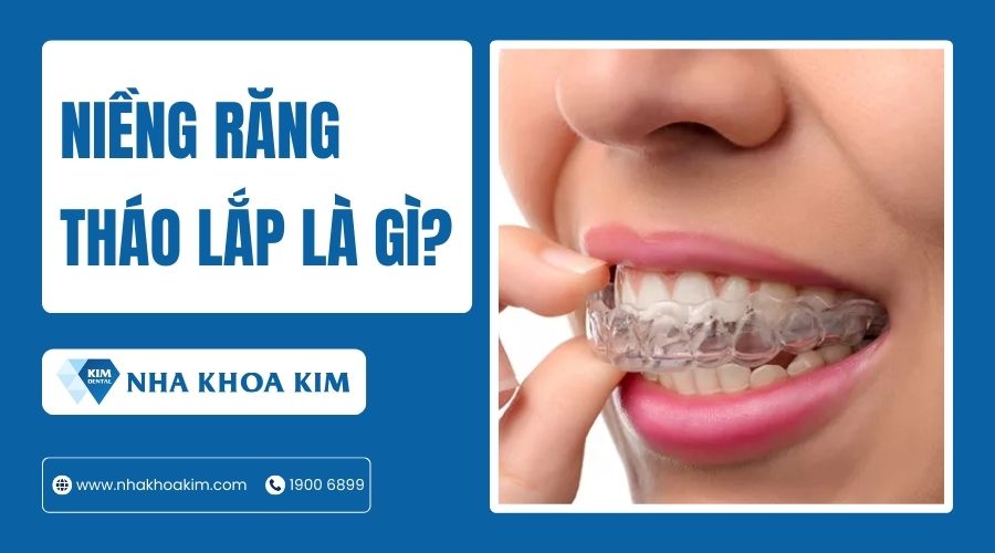Niềng răng tháo lắp là gì?