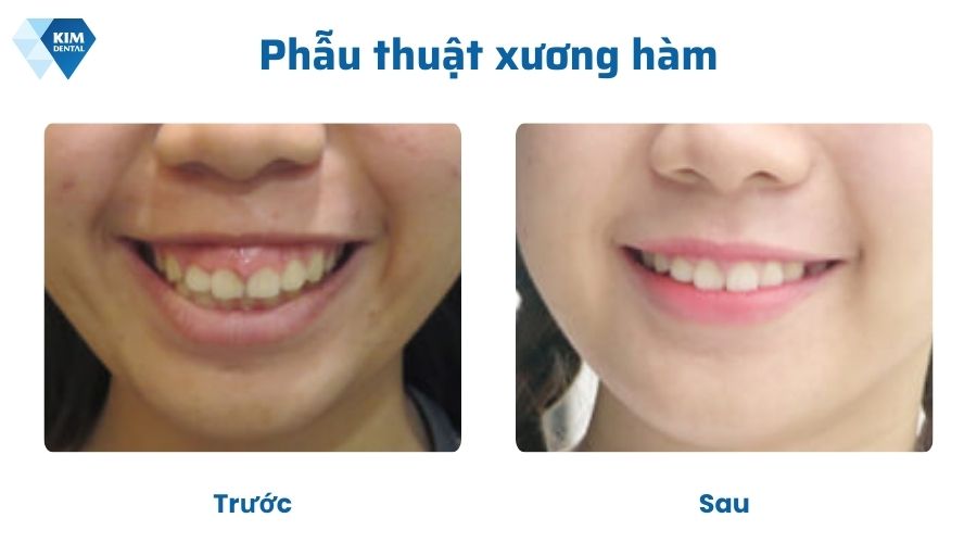 Phẫu thuật xương hàm chỉnh răng mọc lệch không cần niềng