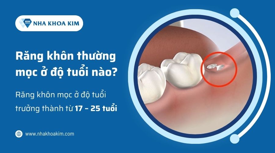 Răng khôn thường mọc ở độ tuổi nào
