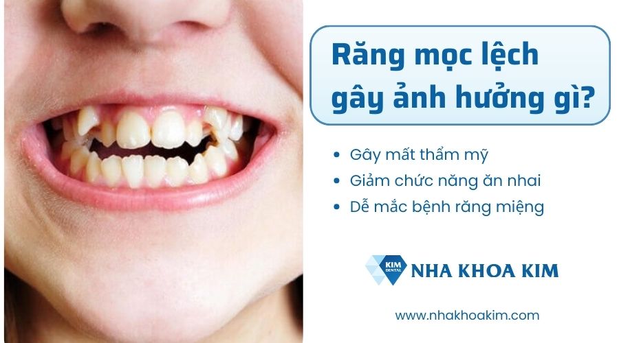Tại sao cần chỉnh răng mọc lệch?
