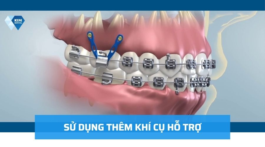 Sử dụng các công cụ hỗ trợ niềng răng