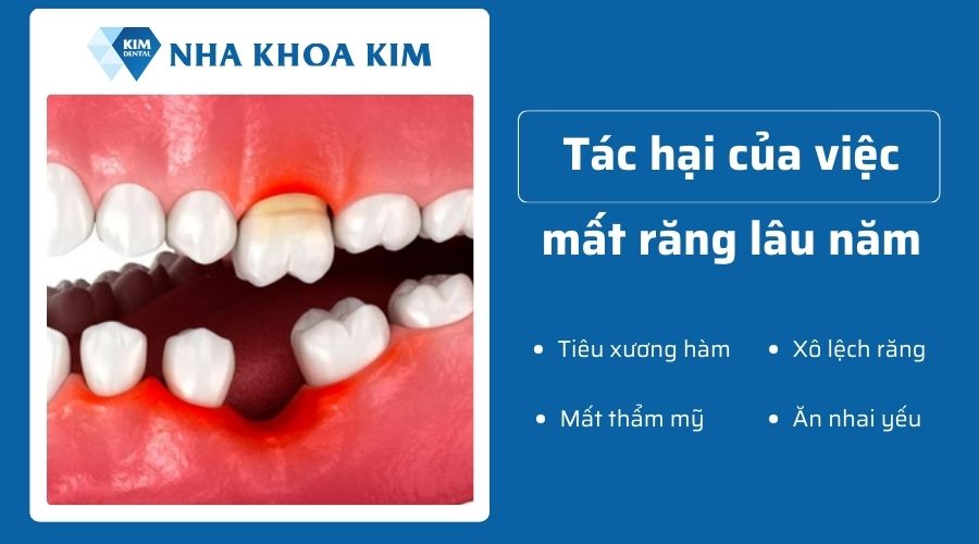 Mất răng lâu năm không trồng Implant có sao không?