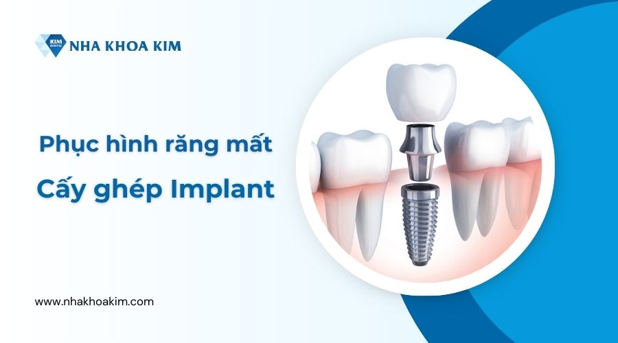 Trồng răng sứ vĩnh viễn trên implant