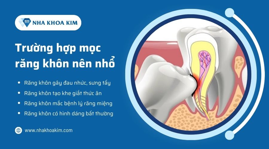 Nên nhổ răng khôn khi nào?