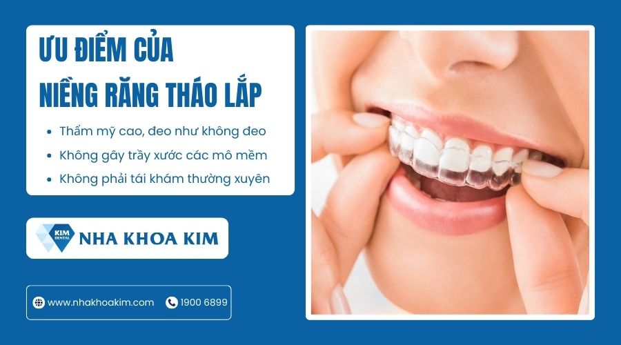 Ưu điểm của phương pháp niềng răng tháo lắp