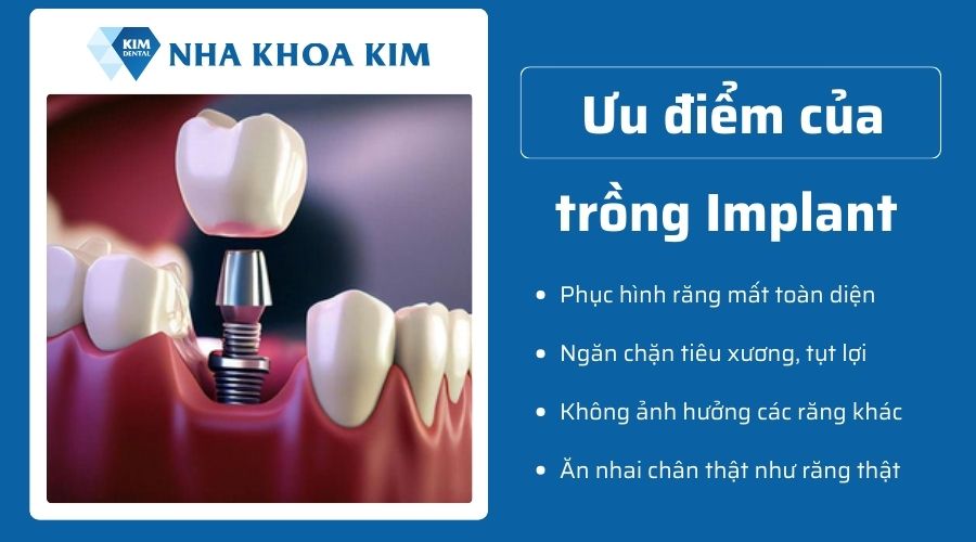 Tại sao mất răng lâu năm nên trồng Implant?