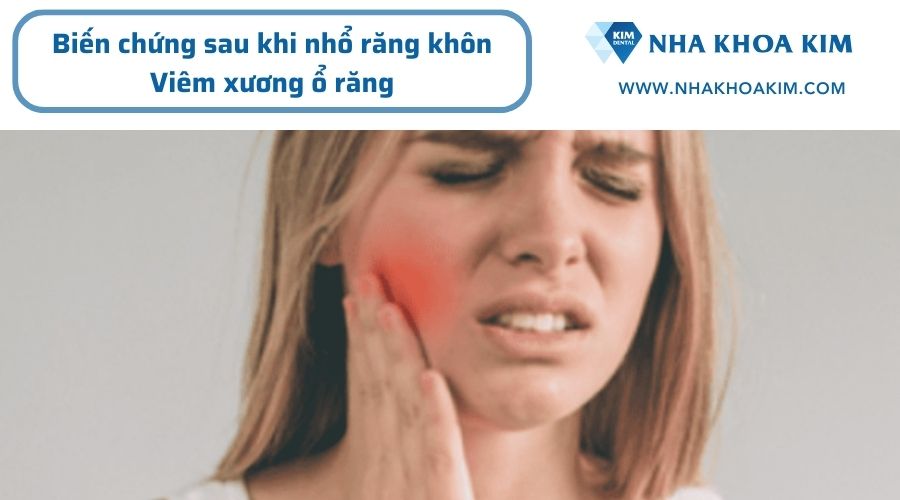 Biến chứng sau khi nhổ răng khôn mọc lệch