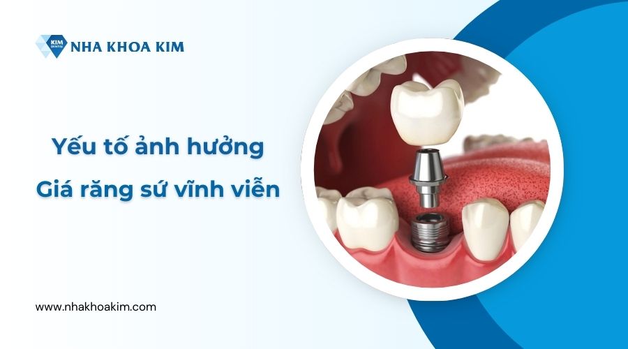 Yếu tố ảnh hưởng đến giá trồng răng sứ vĩnh viễn