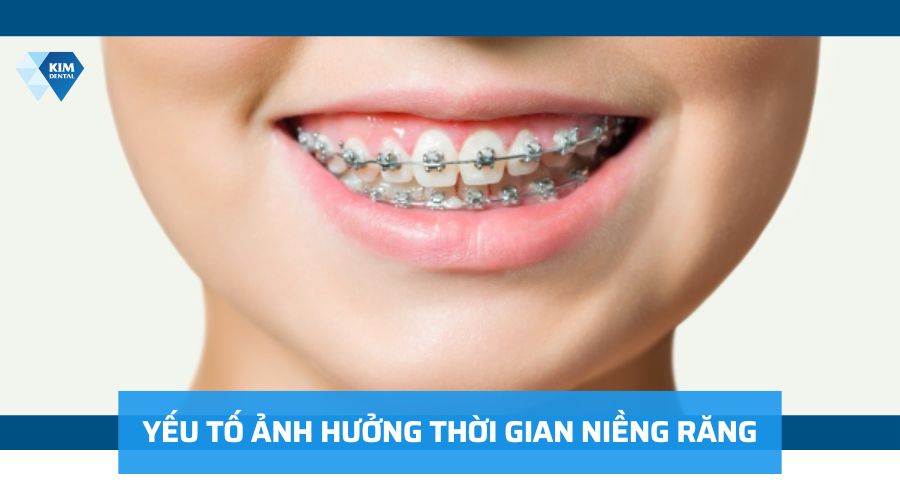 Yếu tố ảnh hưởng đến thời gian niềng răng