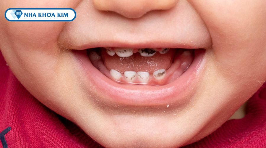 Hình ảnh bộ răng sữa bị sâu
