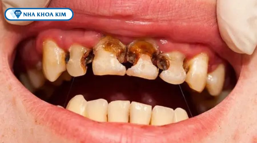 Hình ảnh sâu răng vĩnh viễn