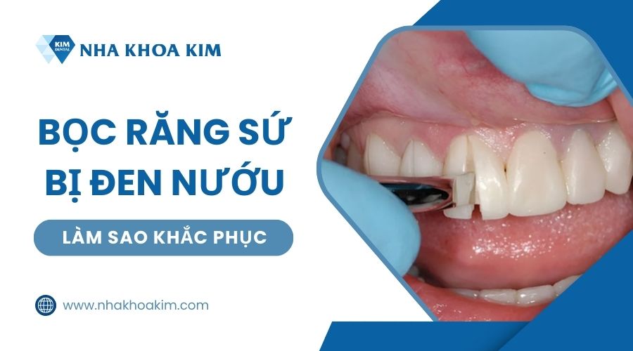 Bọc răng sứ bị đen phải làm sao?