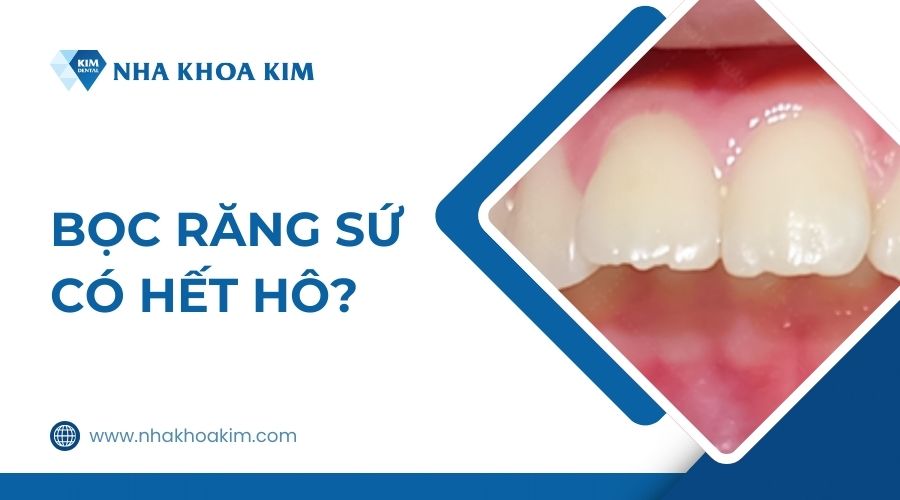 Bọc răng sứ có hết hô không?