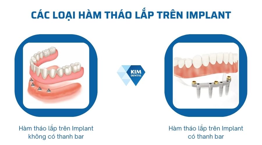 Các loại hàm tháo lắp trên Implant