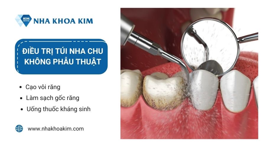 Cách điều trị túi nha chu