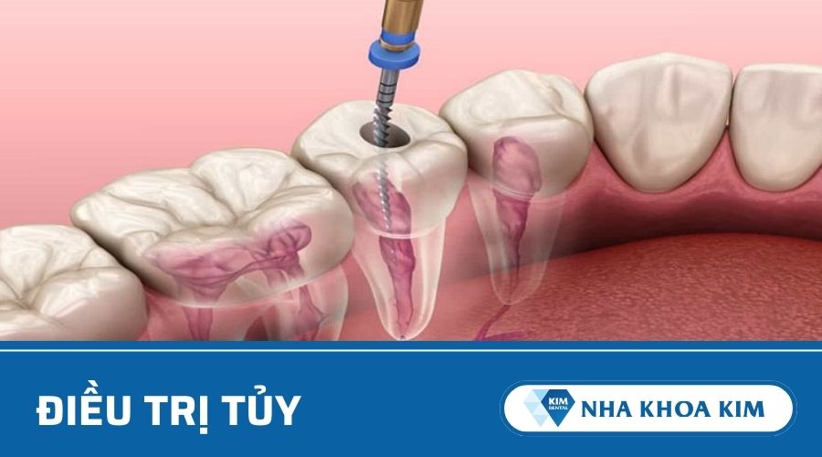 Điều trị tủy răng bị sâu