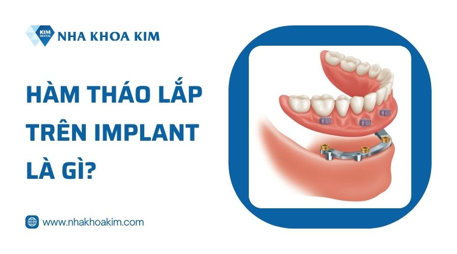 Hàm tháo lắp trên Implant là gì?