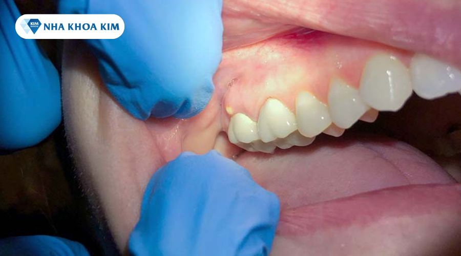 Hình ảnh sưng lợi chân răng có mủ