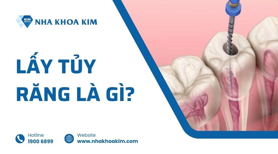 Lấy tủy răng là gì?