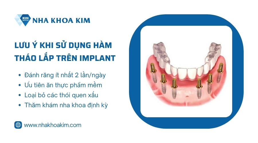 Lưu ý khi sử dụng hàm răng giả tháo lắp trên Implant