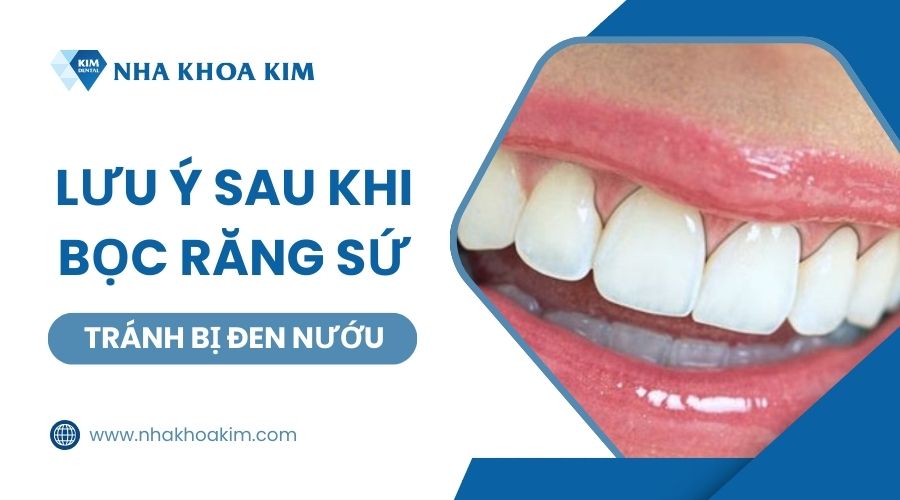 Lưu ý khi bọc răng sứ để tránh bị đen nướu