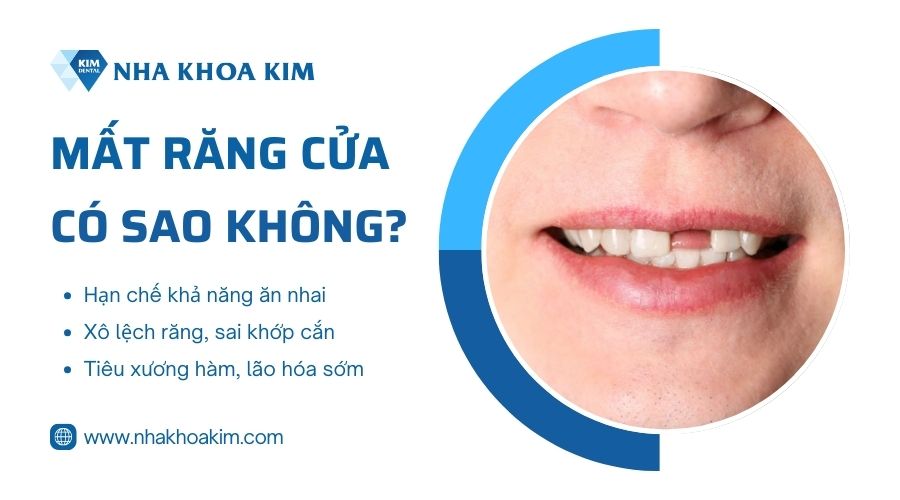 Mất răng cửa có sao không?