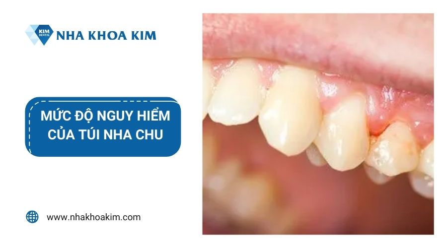 Mức độ nguy hiểm của túi nha chu