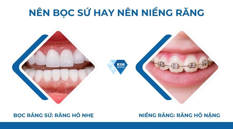 Răng hô nên bọc sứ hay niềng răng?