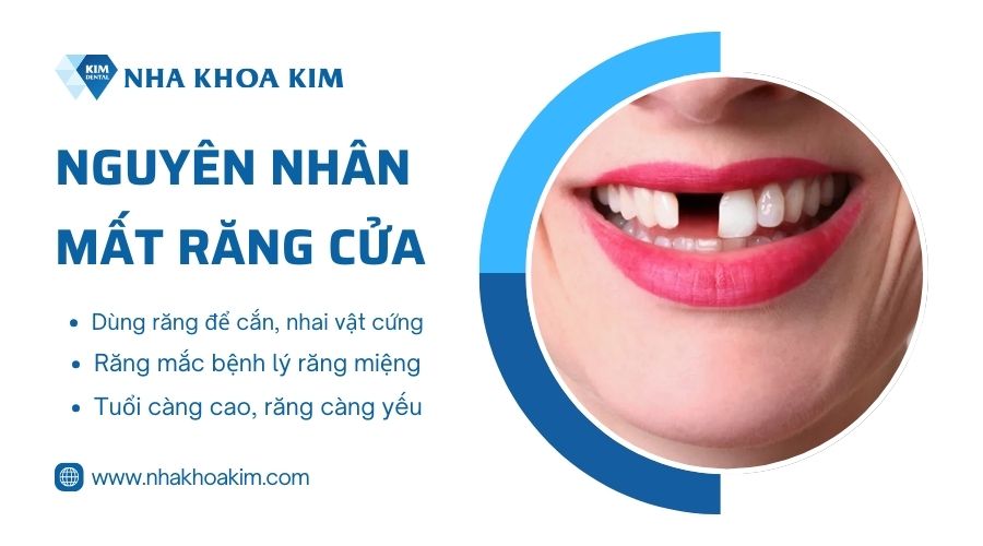 Nguyên nhân mất răng cửa