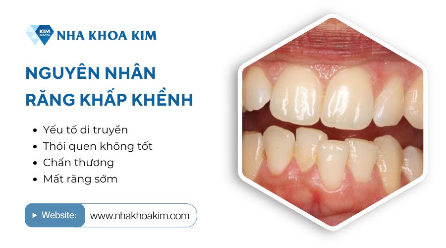 Nguyên nhân răng bị khấp khểnh là gì