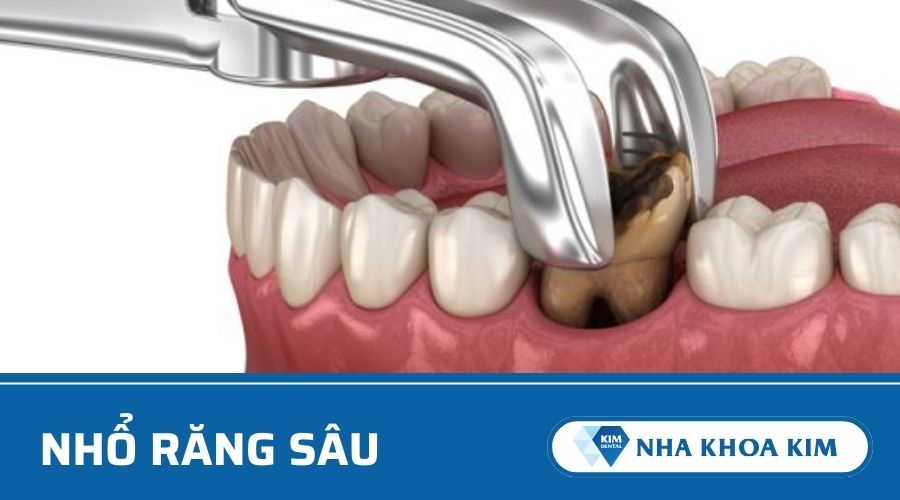 Nhổ răng sâu
