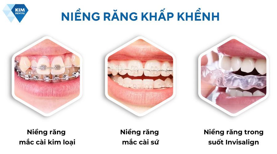 Niềng răng khấp khểnh