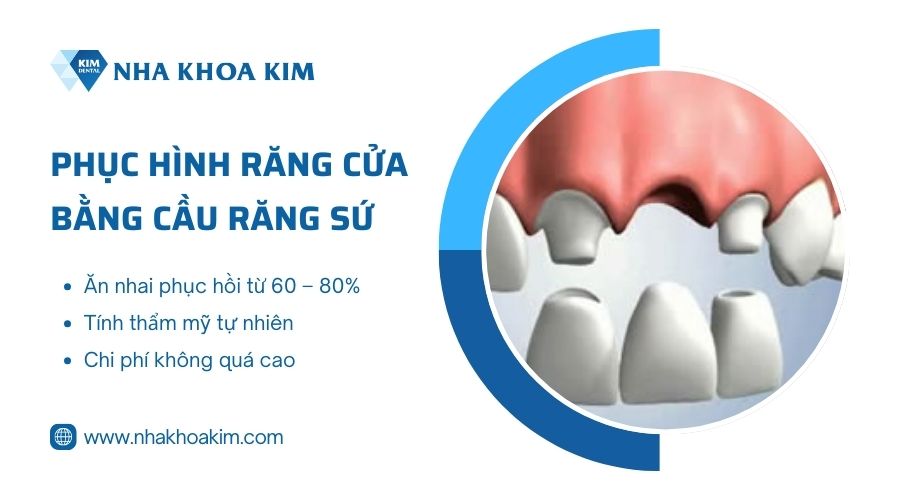 Cầu răng sứ cho răng cửa