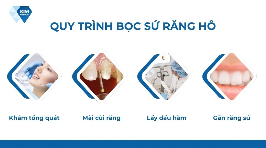 Quy trình bọc sứ răng hô